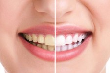 دندان ناسالم باعث سکته مغزی می شود 