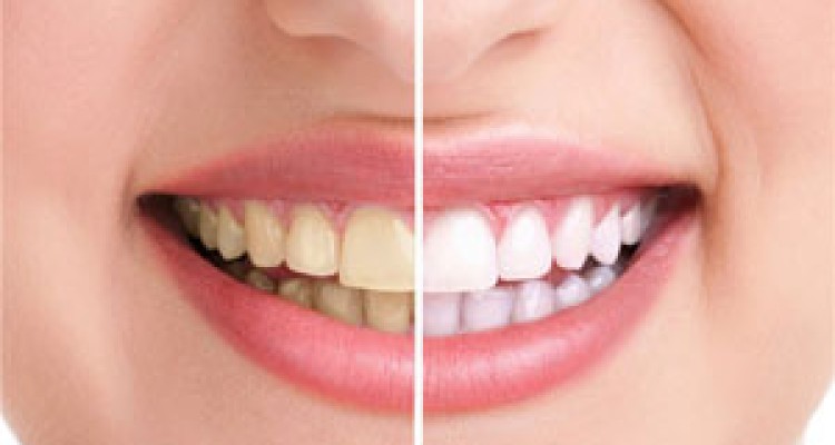 دندان ناسالم باعث سکته مغزی می شود 