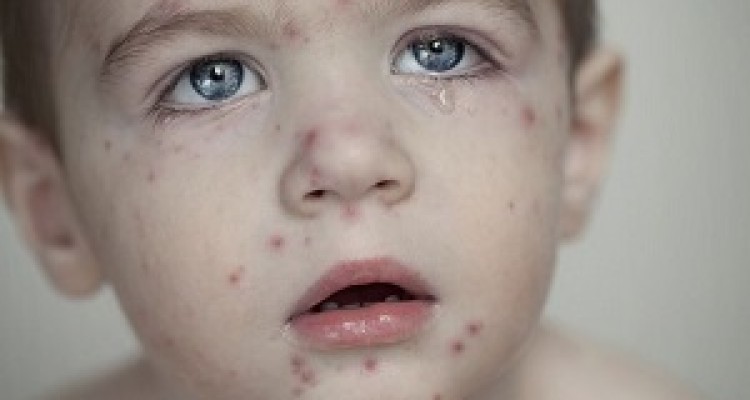 آبله‌مرغان سراغ چه كسانی می‌رود؟ / با این سوپ آبله‌مرغان را در خانه درمان کنید 