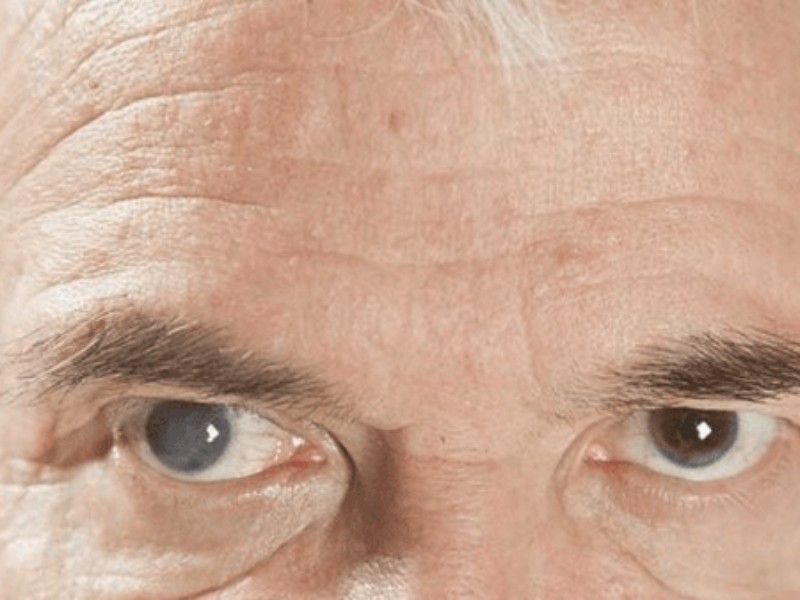 این علائم در چشم را جدی بگیرید